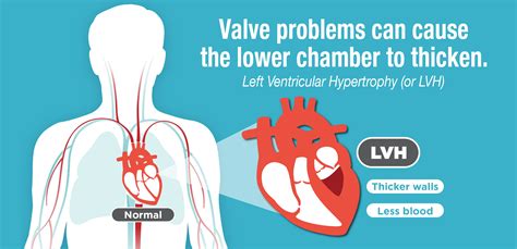 symptoms of left ventricle problems.